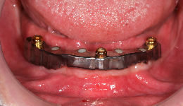 Bar Fixed on Implants